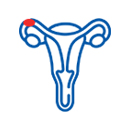 Blocked Fallopian Tubes
