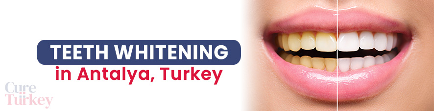 Teeth Whitening- Antalya