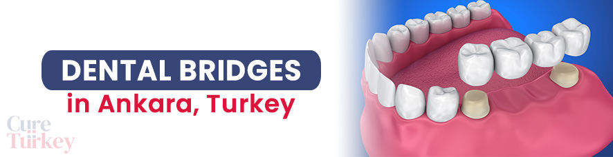 Dental Bridges in Ankara