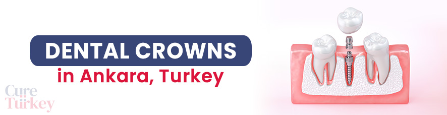Dental Crowns in Ankara