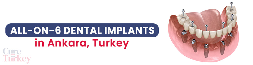 All-on-6 Implants in Ankara