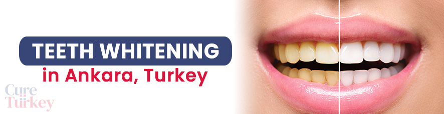 Teeth Whitening- Ankara