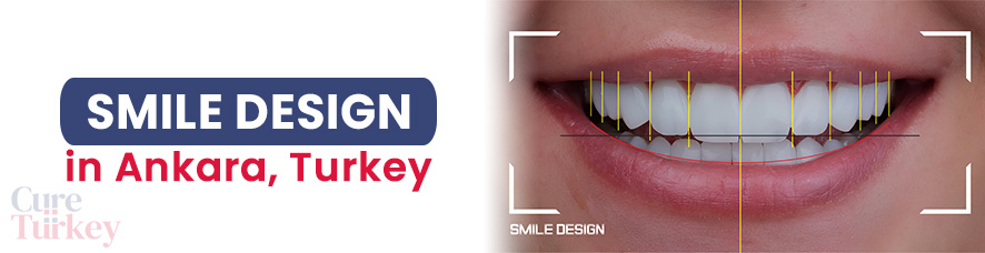Smile Design - Ankara
