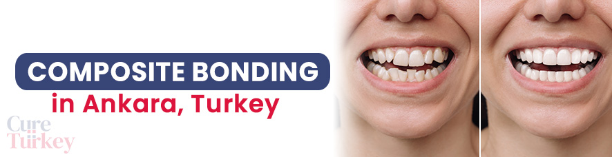 Composite Bonding in Ankara