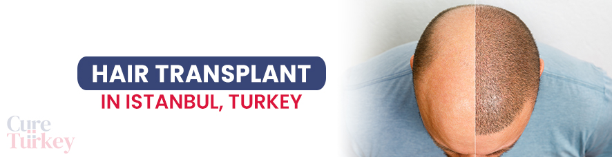 Hair Transplant in Istanbul