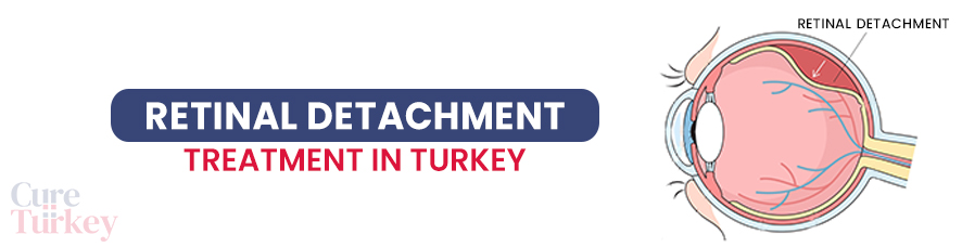 Retinal Detachment