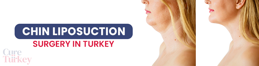 Chin Liposuction