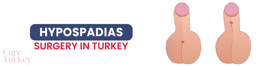 Hypospadias Surgery
