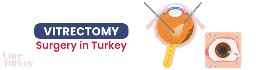 Vitrectomy
