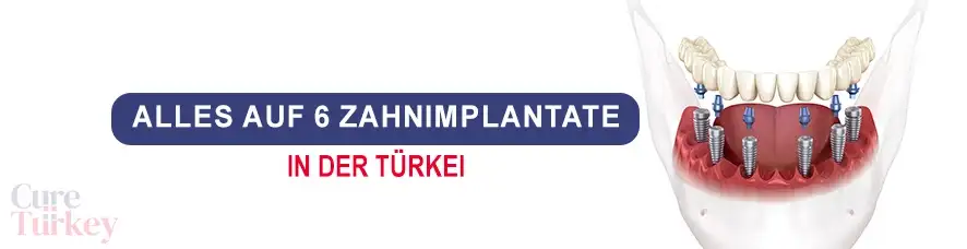 Alles auf 6 Zahnimplantate