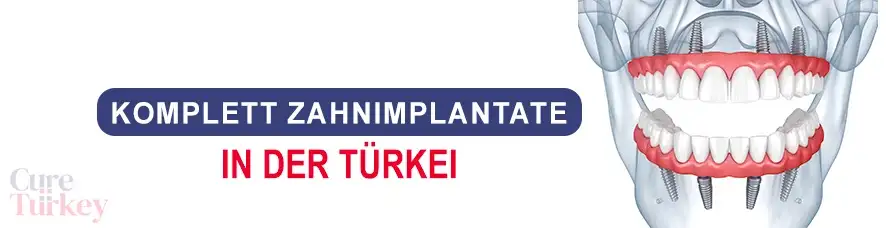 Alles-auf-4 Zahnimplantate