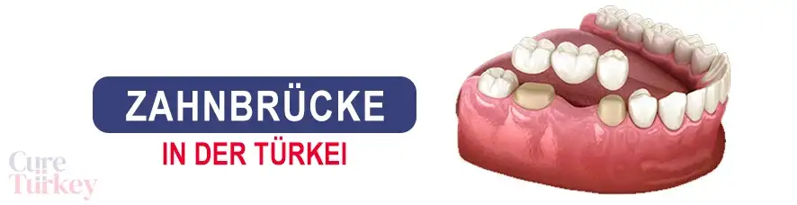 Zahnbrücke, Zahnbrücken
