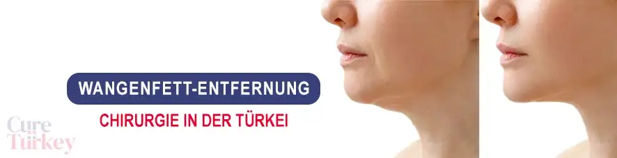 Wangenfett-Entfernung