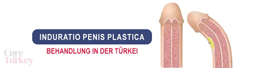 Behandlung der Induratio penis plastica in der Türkei