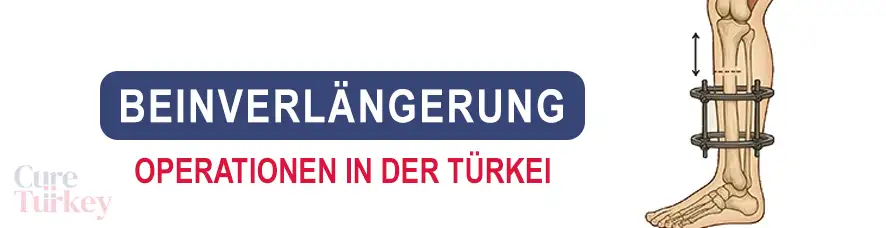 Beinverlängerung Operationen in der Türkei