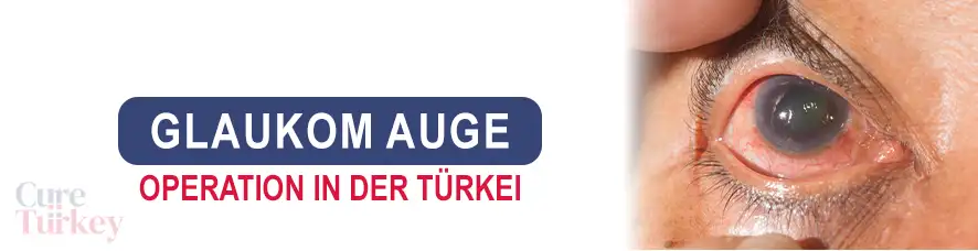 glaukom auge in der Türkei