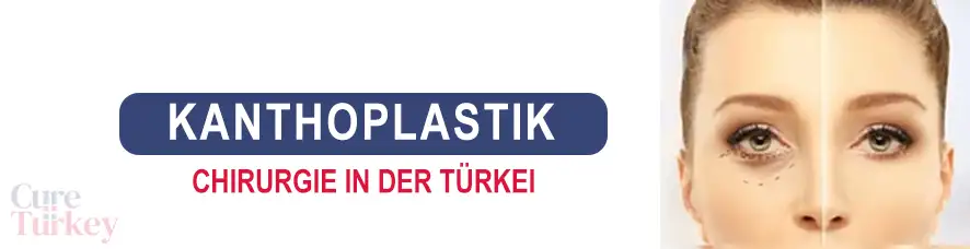 Kanthoplastik in der Türkei