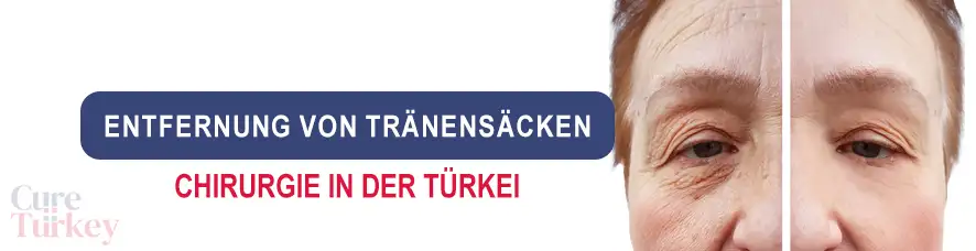 Entfernung von Tränensäcken in der Türkei
