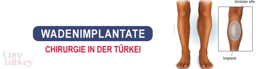 Wadenimplantate in der Türkei