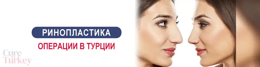 Ринопластика