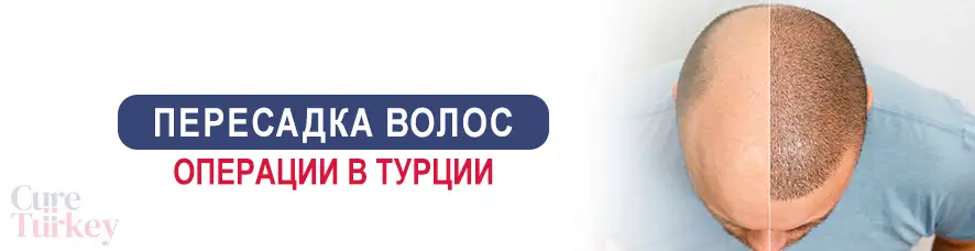 Пересадка волос