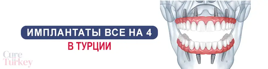 Имплантаты все на 4