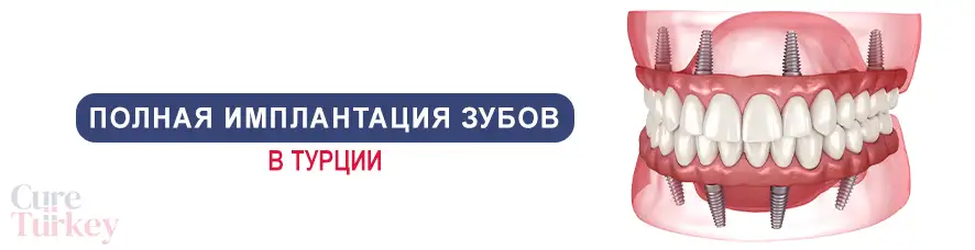 Полная имплантация зубов
