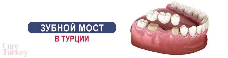 Зубной мост