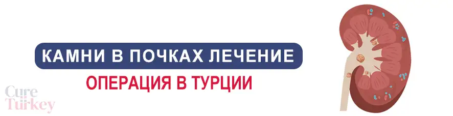 Камни в почках лечение