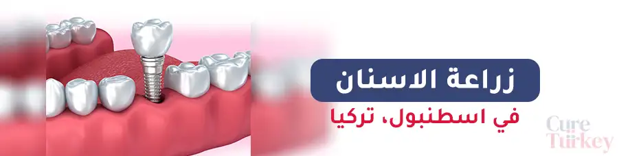 زراعة الاسنان في اسطنبول