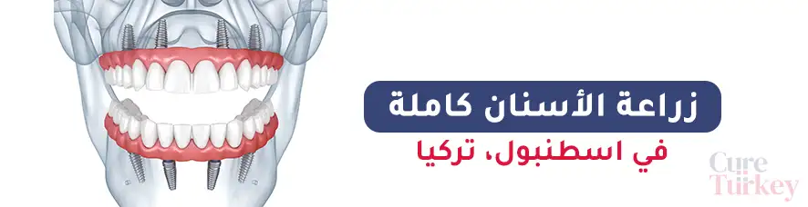 زراعة الأسنان كاملة في اسطنبول