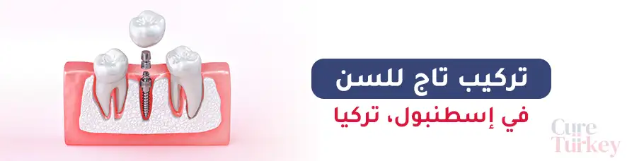 تركيب تاج للسن في اسطنبول