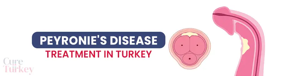 Peyronies Disease Treatment