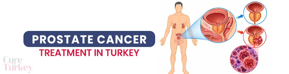 Prostate Cancer Treatment