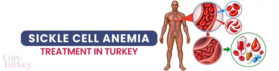Sickle Cell Anemia