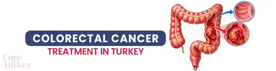 Colorectal Cancer