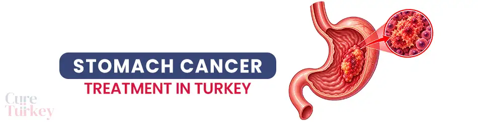 Stomach Cancer (Gastric Cancer)