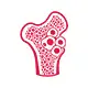 Multiple Myeloma