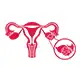 Ovarian Cancer